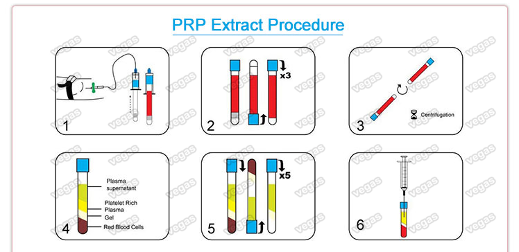 Processure de PRP
