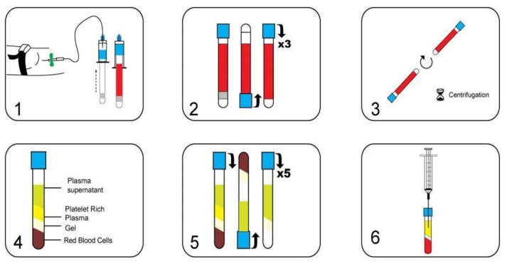 Procedimiento de PRP